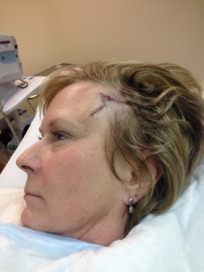 2014-03-05 11-45-14 Basal Cell Carcinoma surgery.jpg